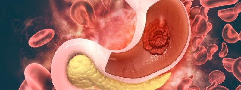 Magenbypass -Operation im Ausland